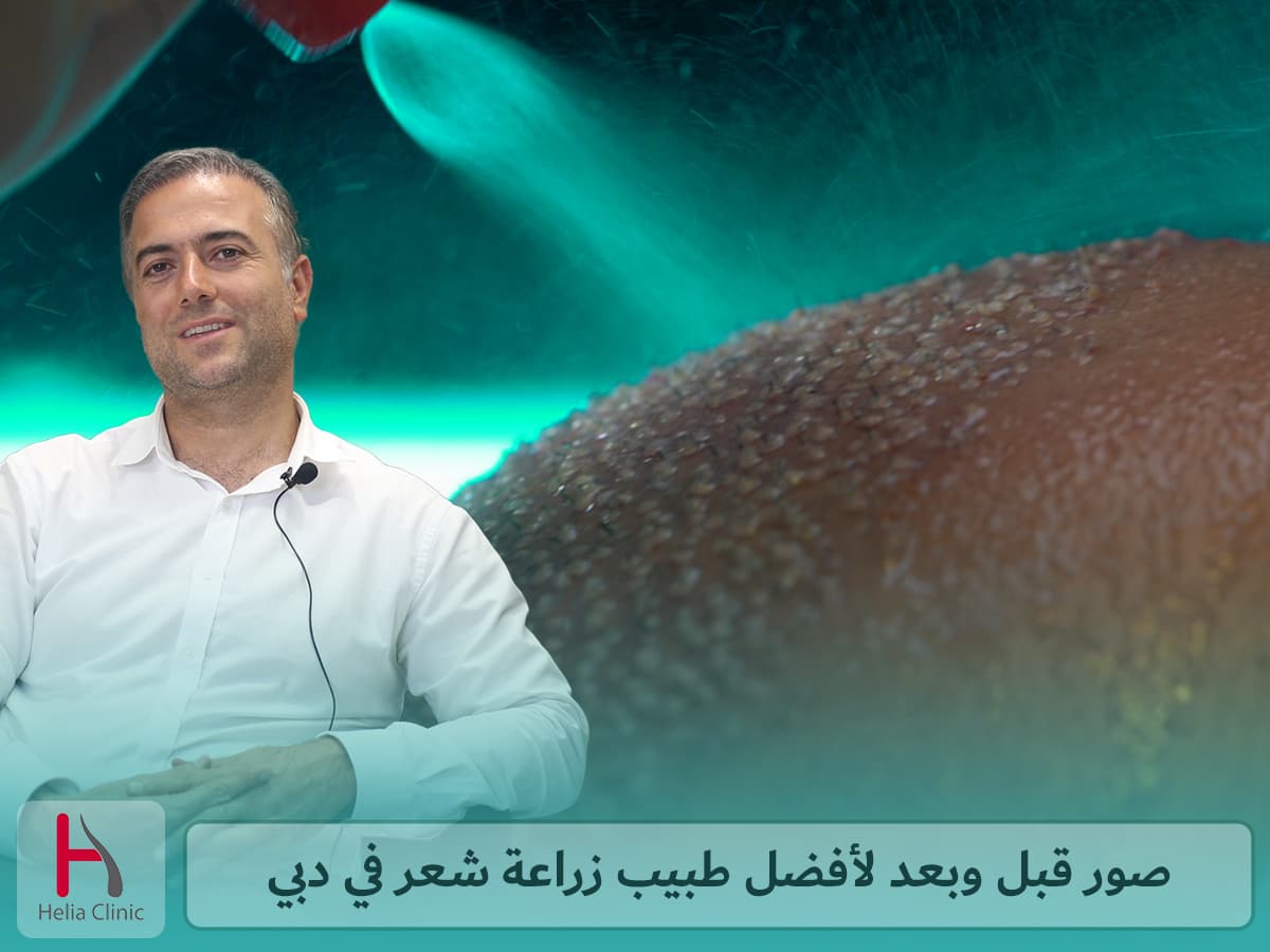 أمثلة من أفضل أطباء زراعة الشعر في دبي