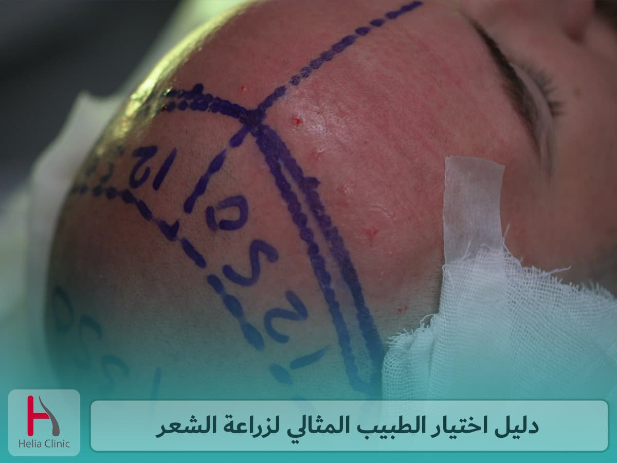 كيف تختار طبيب زراعة الشعر الخاص بك؟