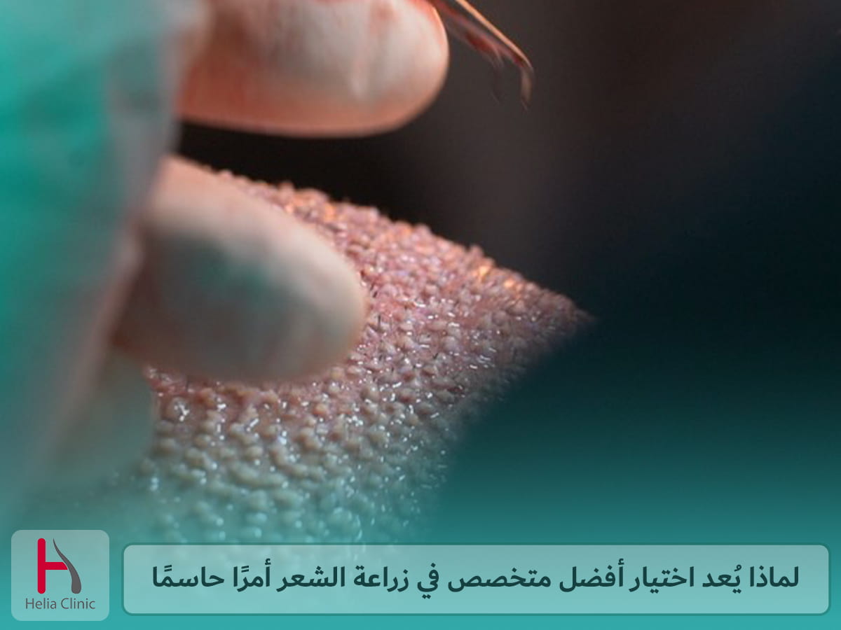 أهمية اختيار أفضل متخصص في زراعة الشعر
