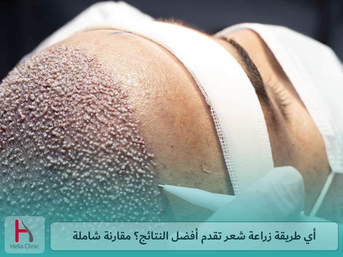 مقارنة نتائج طرق زراعة الشعر المختلفة