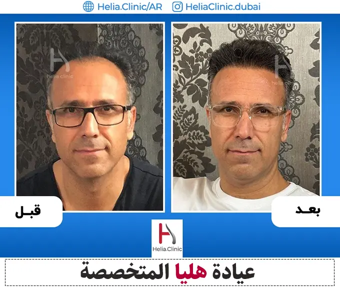 النتيجة الكاملة لعملية زراعة الشعر