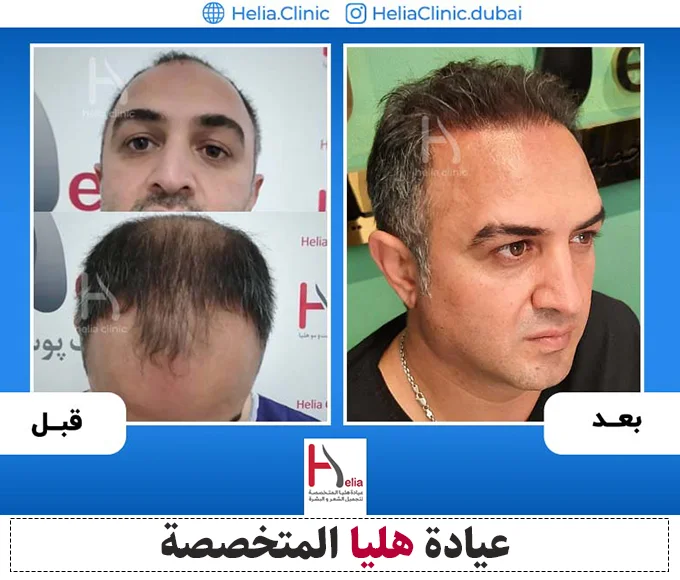 تجربة زراعة الشعر مع الدكتور الخراساني