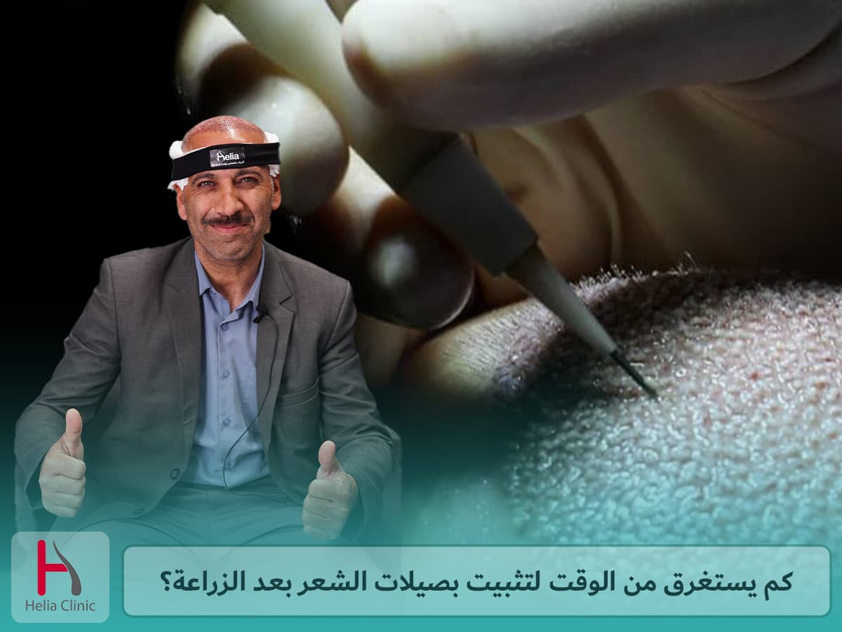 متى تثبت بصيلات الشعر بعد عملية زراعة الشعر؟