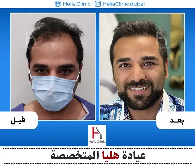 صورة لأفضل طريقة لزراعة الشعر في العالم