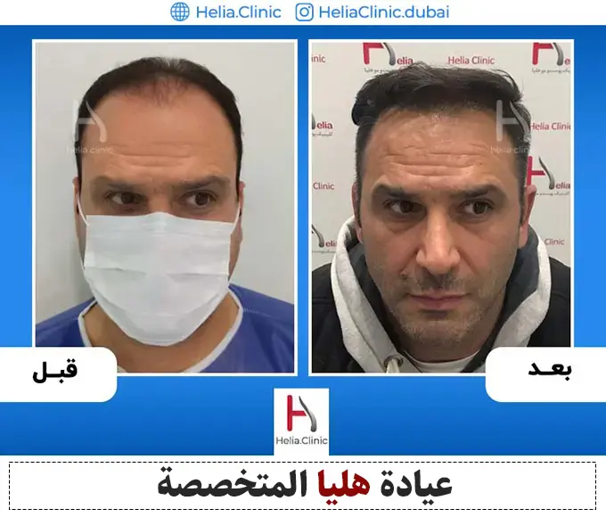 صورة زراعة الشعر في أفضل عيادة في دبي
