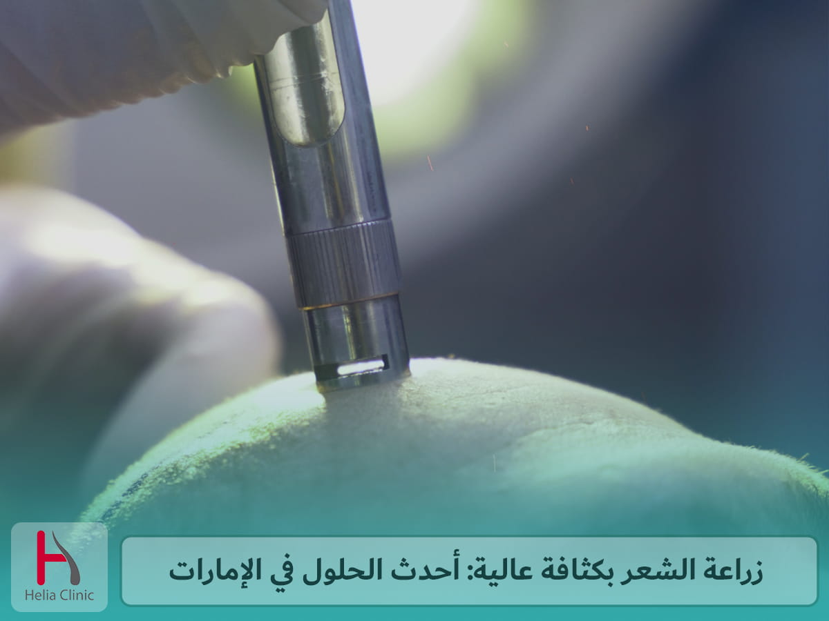 أحدث تقنيات زراعة الشعر في الإمارات بكثافة عالية