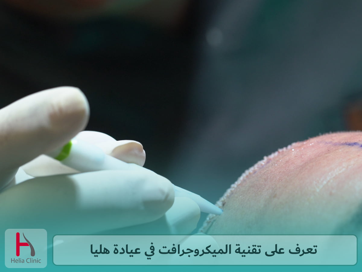 تقنية ميكروجرفت: أحدث تقنية زراعة الشعر في عيادة هليا