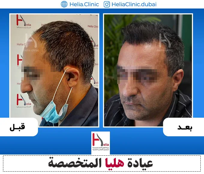 صور قبل وبعد تقنية زرع الشعر المتقدمة