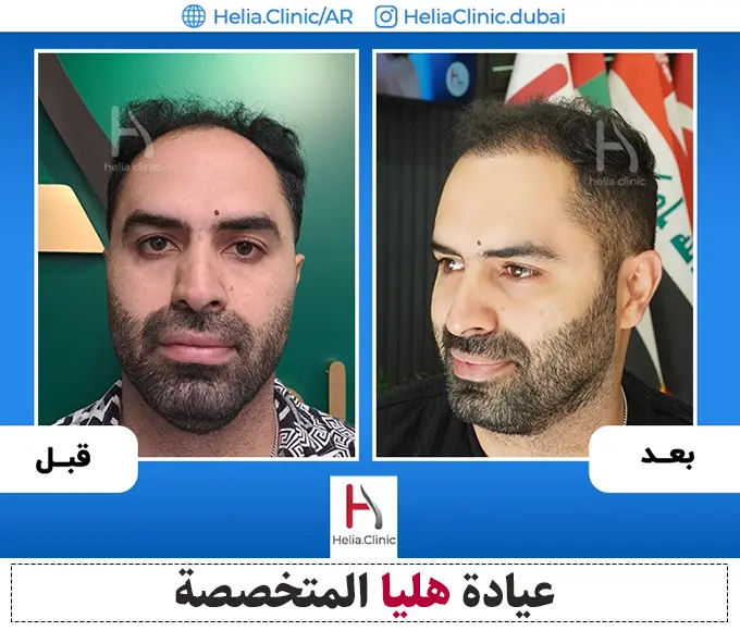 صورة من تجربتي مع أفضل دكتور زراعة شعر في عيادة هليا