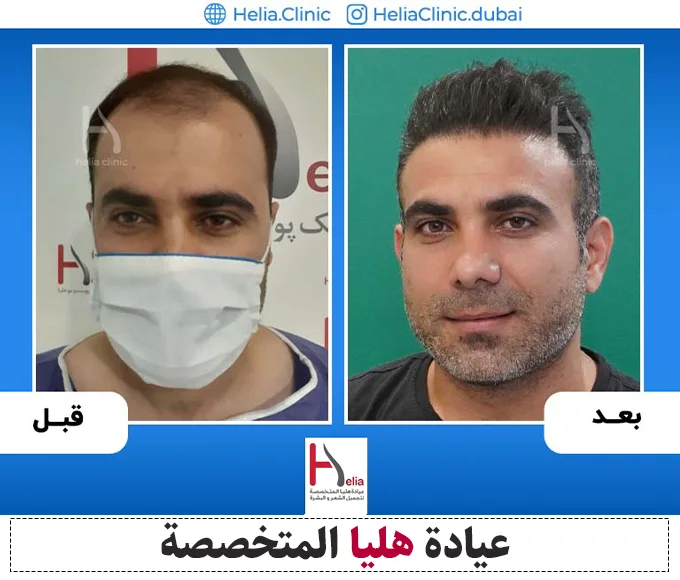 صورة لنمو الشعر المزروع