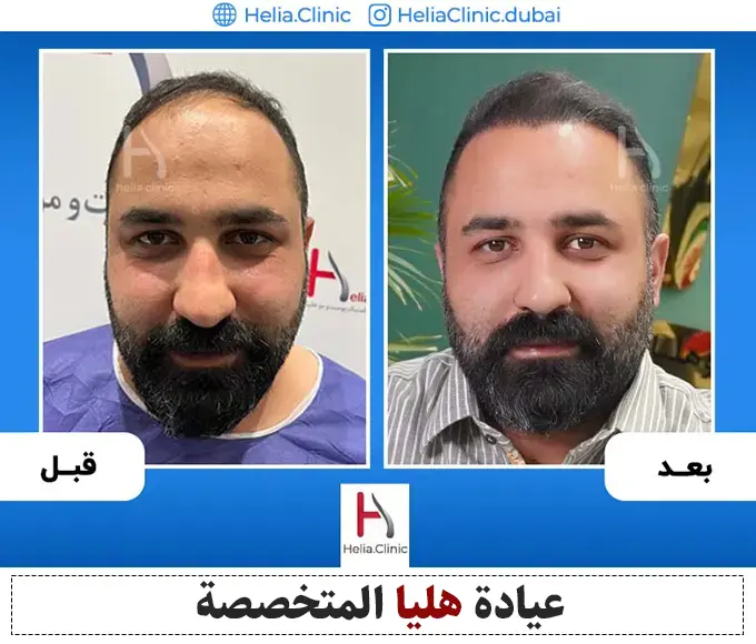 صورة لأحدث طريقة لزراعة الشعر بكثافة عالية