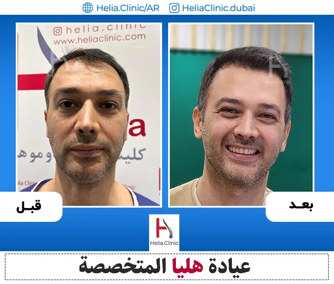 عينات العمل الطريقة الأكثر فعالية لزراعة الشعر