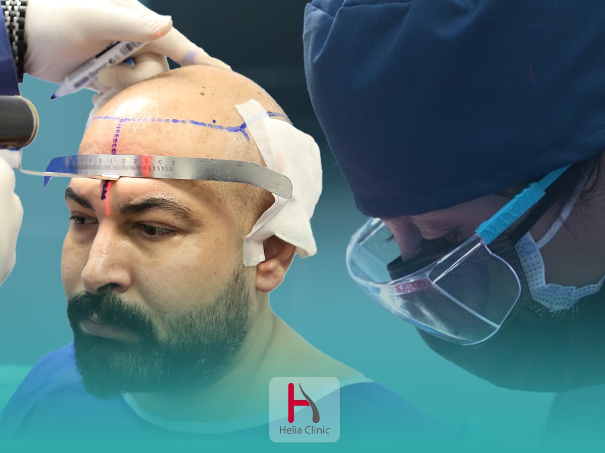 أفضل وقت لزراعة الشعر