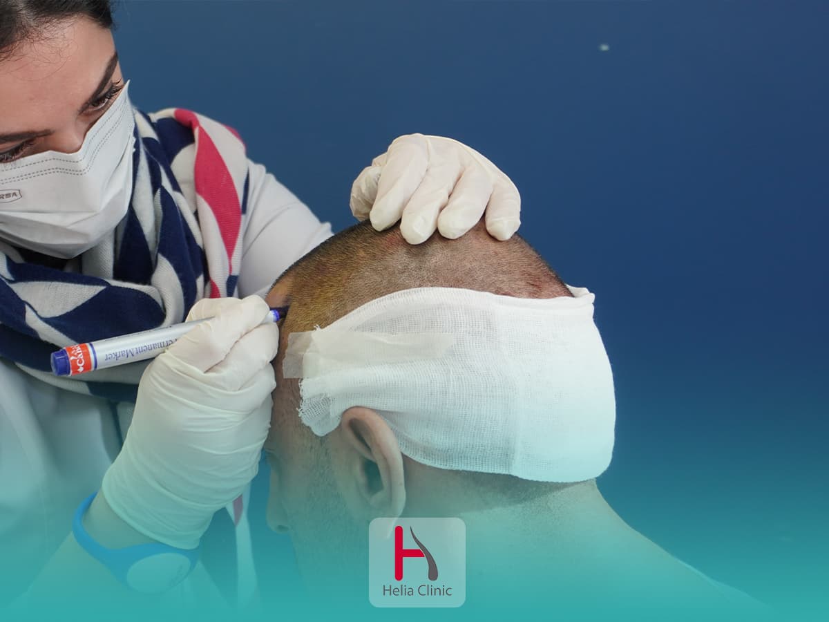 تقنيات حديثة في زراعة الشعر