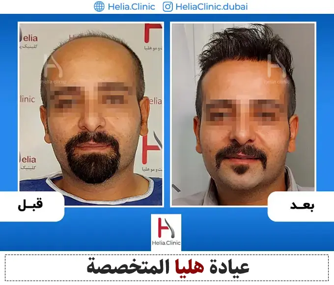 أفضل نتيجة زراعة الشعر