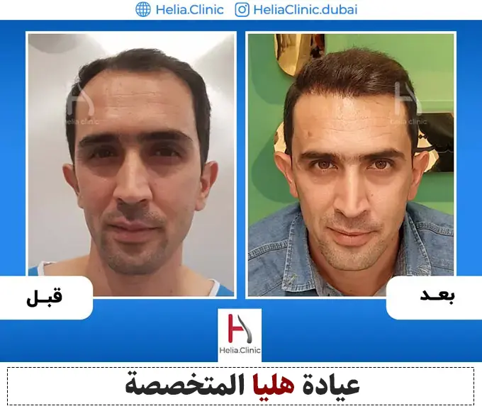 النتيجة النهائية لزراعة الشعر