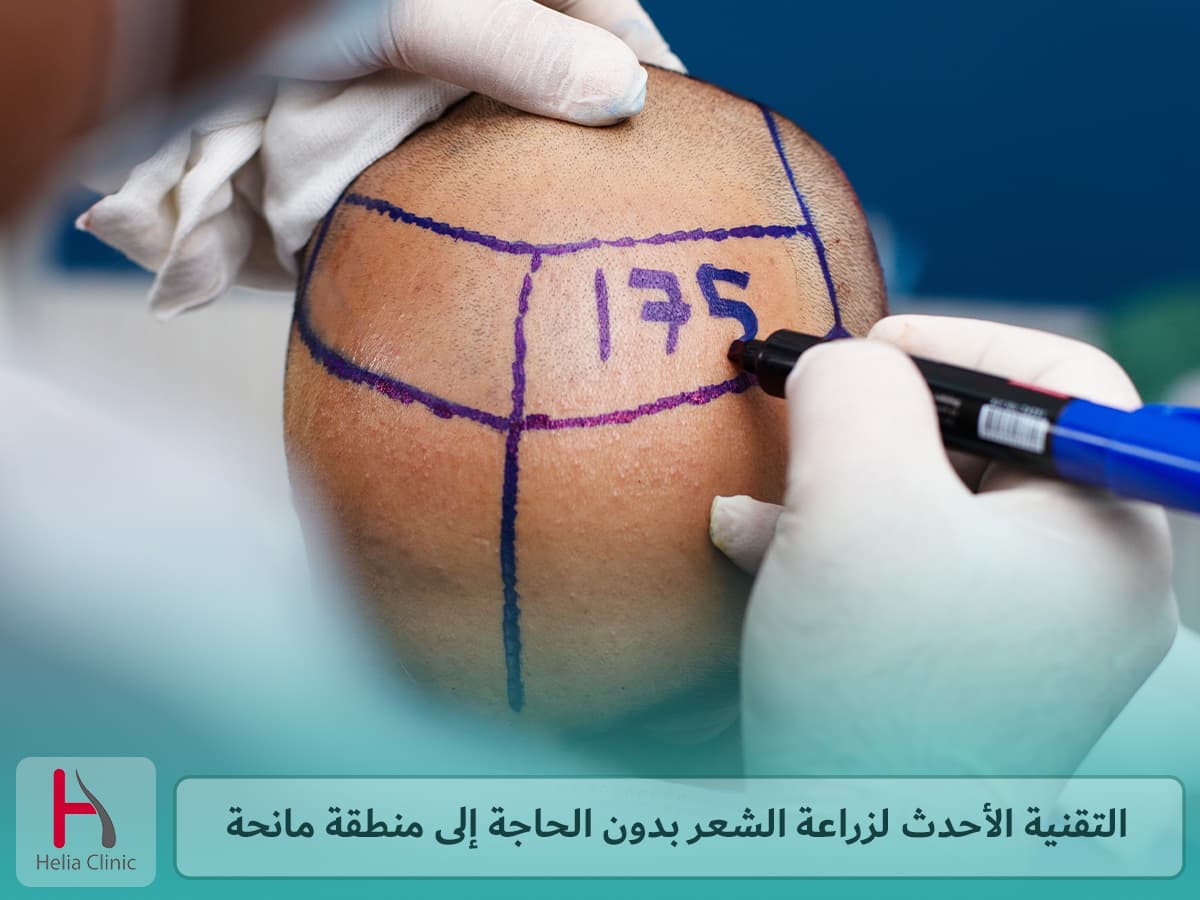 أحدث تقنية زراعة الشعر للأشخاص مع المنطقة المانحة ضعيفة