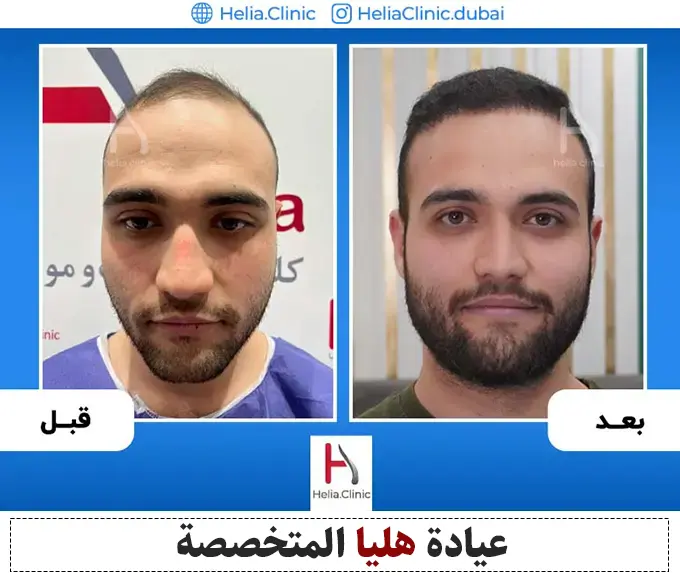 تجربتي مع زراعة الشعر في دبي