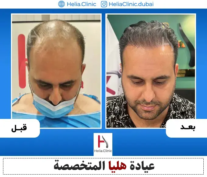 صورة أحدث طريقة لزراعة الشعر في دبي