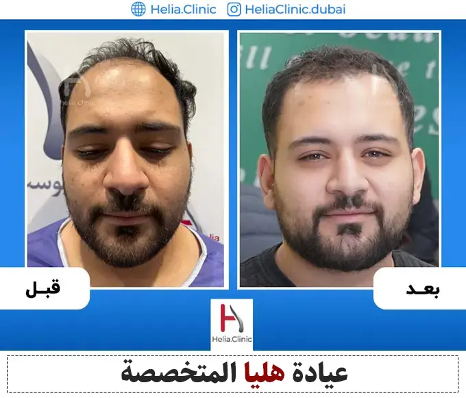 نتائج زراعة الشعر بعد 6 شهور