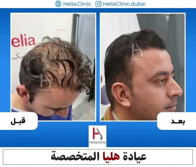 نتيجة زراعة الشعر بعد سنة واحدة