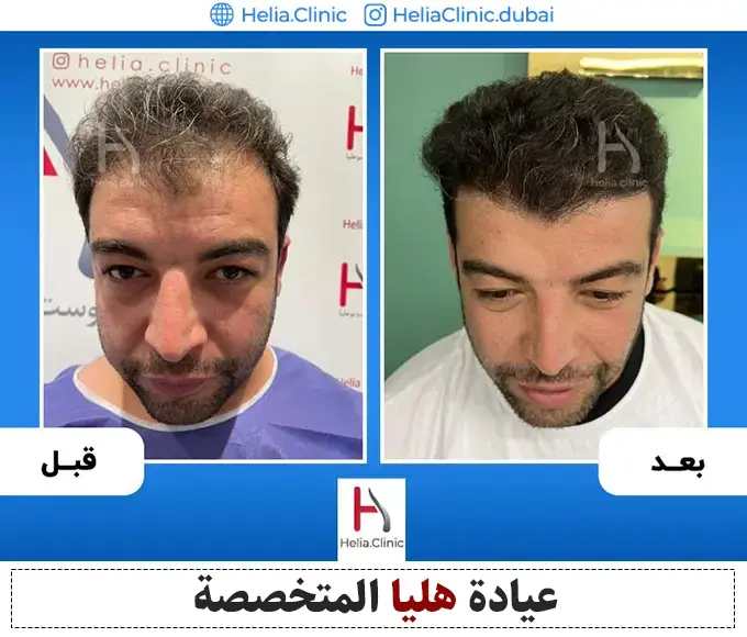 نتيجة زراعة الشعر بعد ثلاثة أشهر