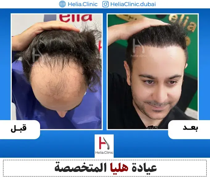 صور زراعة الشعر مع أفضل طبيب في دبي | 2024