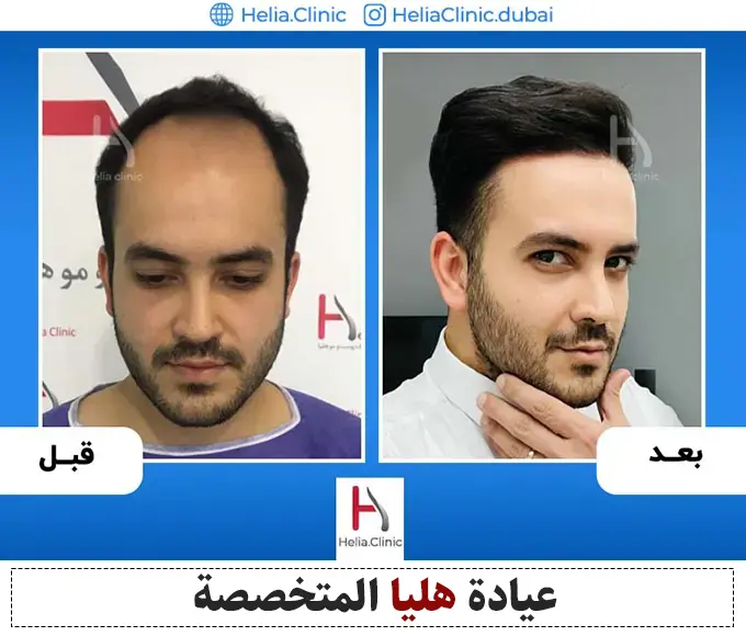 نتيجة أحدث طرق زراعة الشعر بجهاز