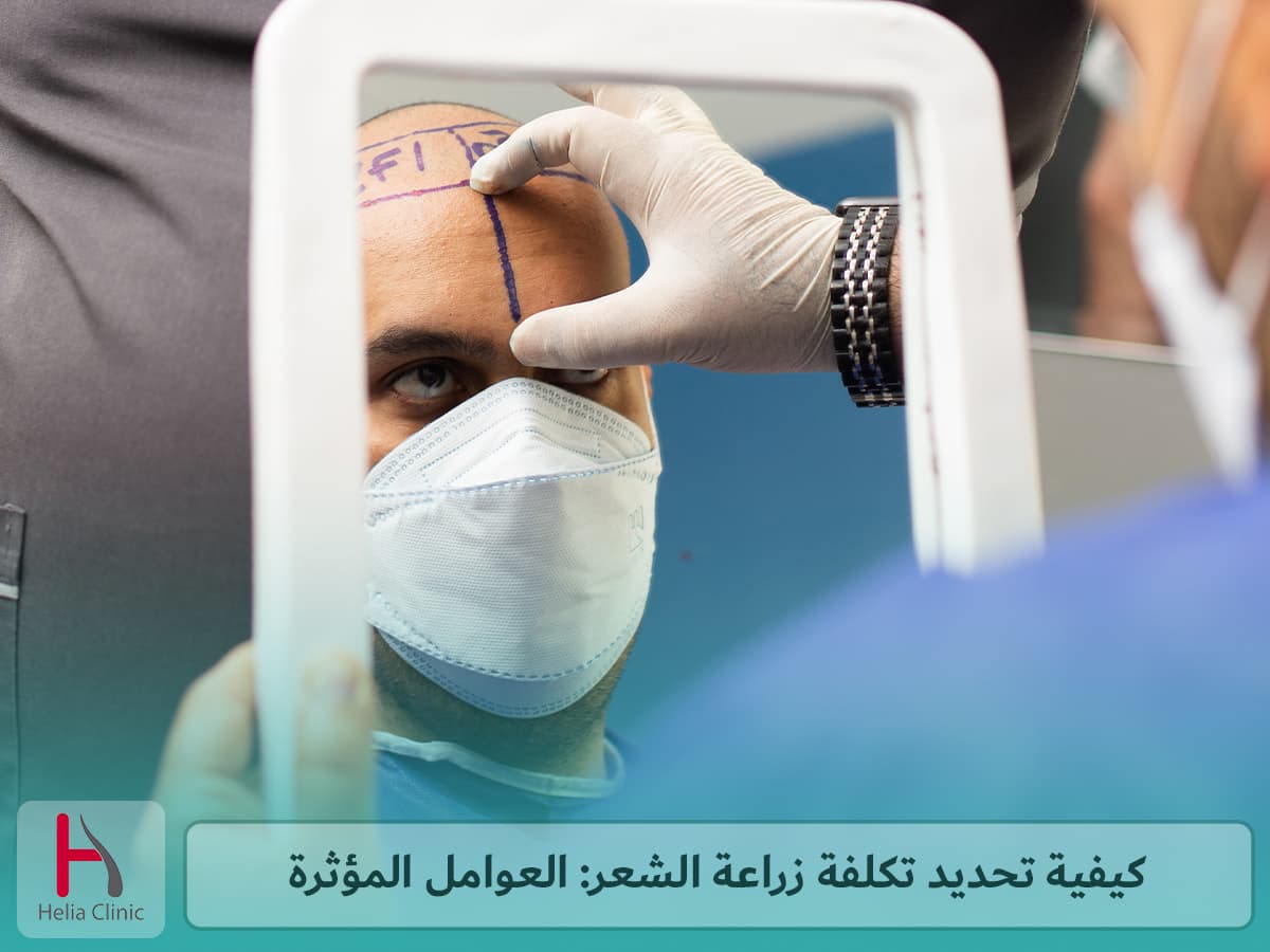 العوامل المؤثرة على تكلفة زراعة الشعر