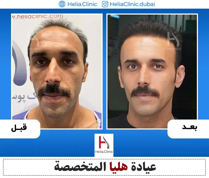 محفظة زراعة الشعر في عيادة هليا