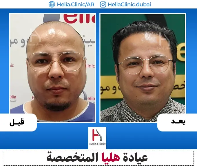 ما هو سعر عملية زراعة الشعر