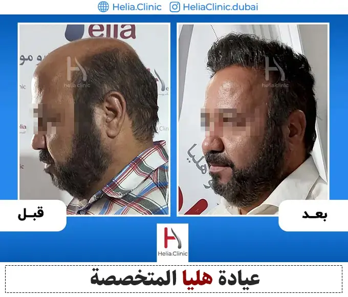 أسعار زراعة الشعر في الإمارات