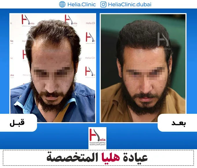 سعر عملية زرع الشعر للدكتور حامد رضا الخراساني