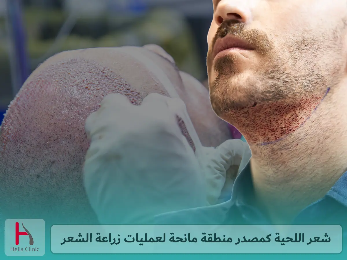 المنطقة المانحة من شعر اللحية