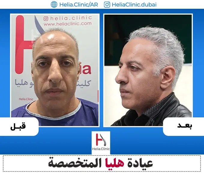 صور قبل وبعد زراعة الشعر بتقنية DHI