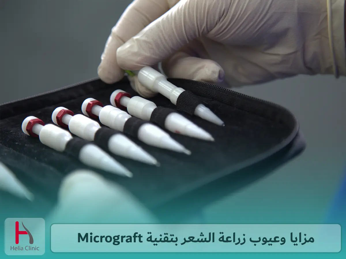 مزايا وعيوب زراعة الشعر بتقنية Micrograft