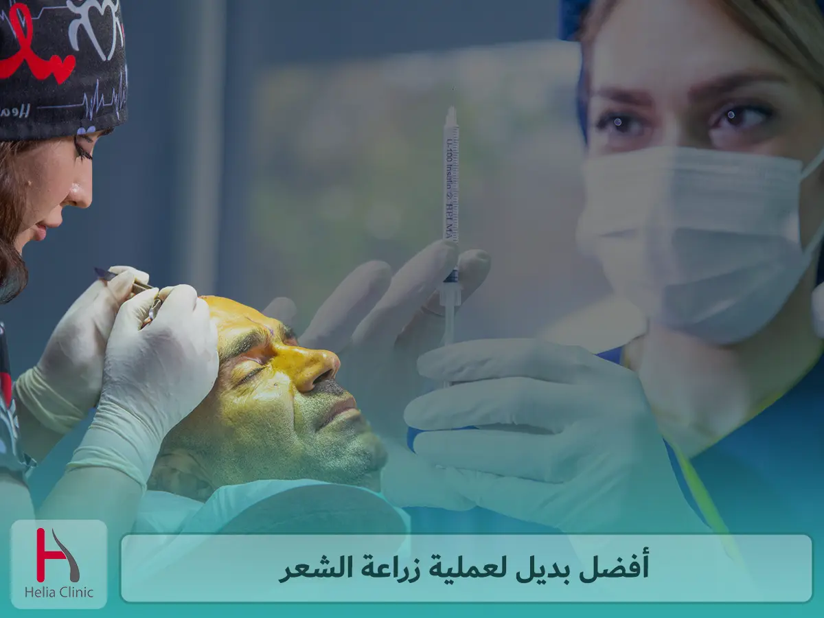 أفضل بديل لعملية زراعة الشعر