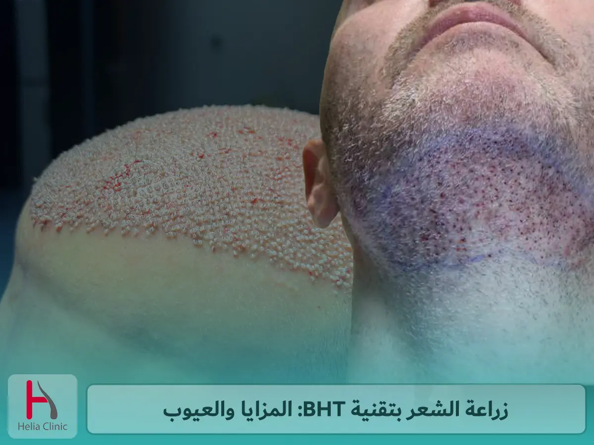 زراعة الشعر بتقنية BHT: المزايا والعيوب