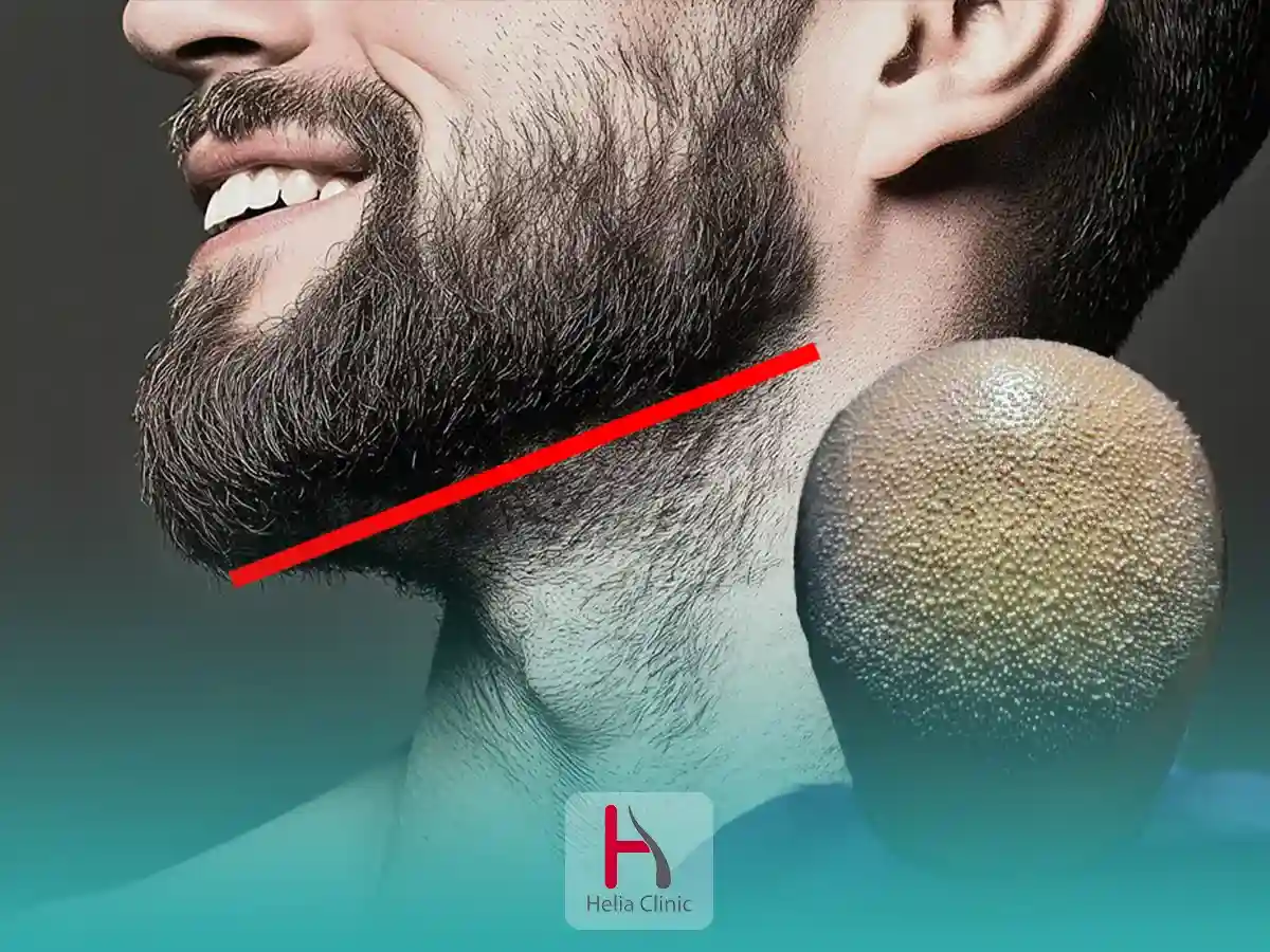 زراعة الشعر باستخدام شعر الجسم BHT