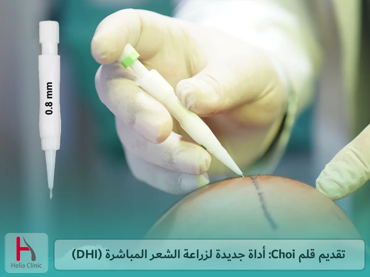 تقديم قلم Choi: أداة جديدة لزراعة الشعر المباشرة (DHI)