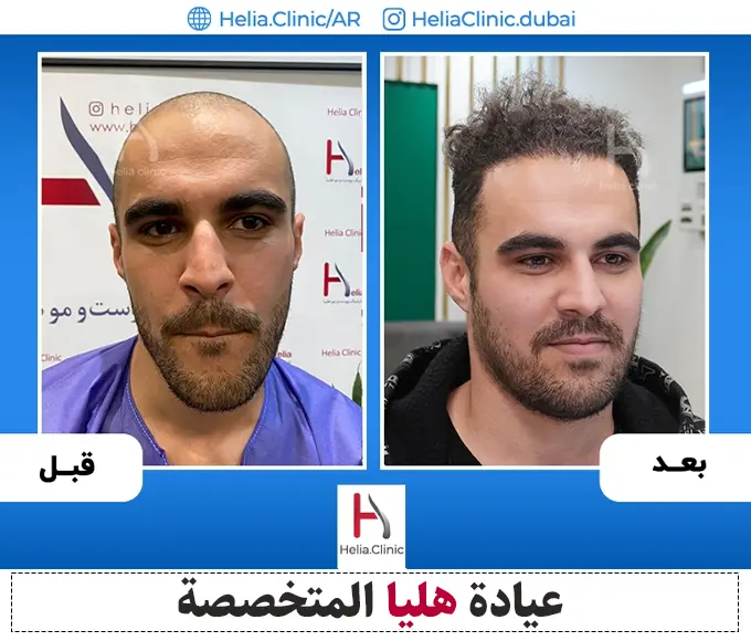 زراعة الشعر الطبيعي بطريقة DHI على يد الدكتور الخراساني