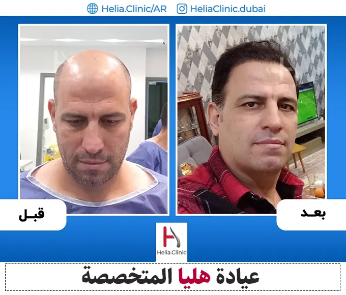 صورة مثال تقنية زراعة الشعر بأقلام تشوي
