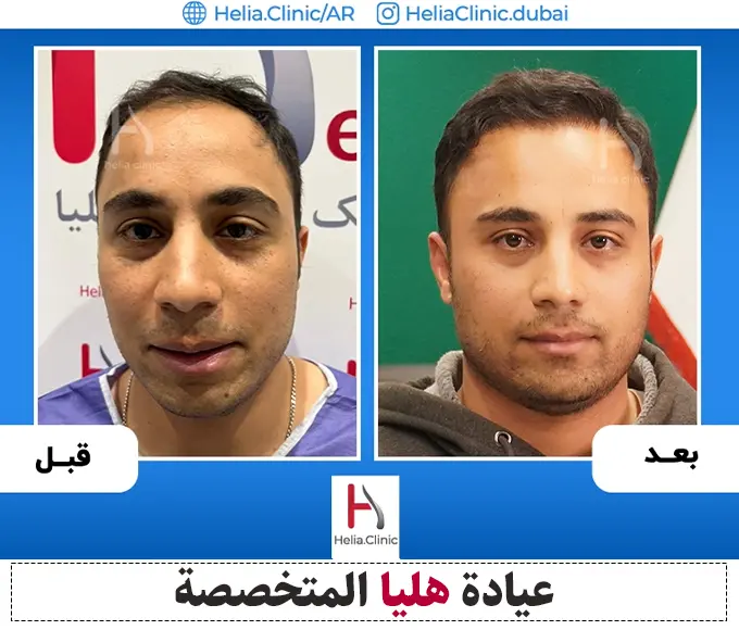 زراعة الشعر بطريقة میکروجرافت في عيادة هليا
