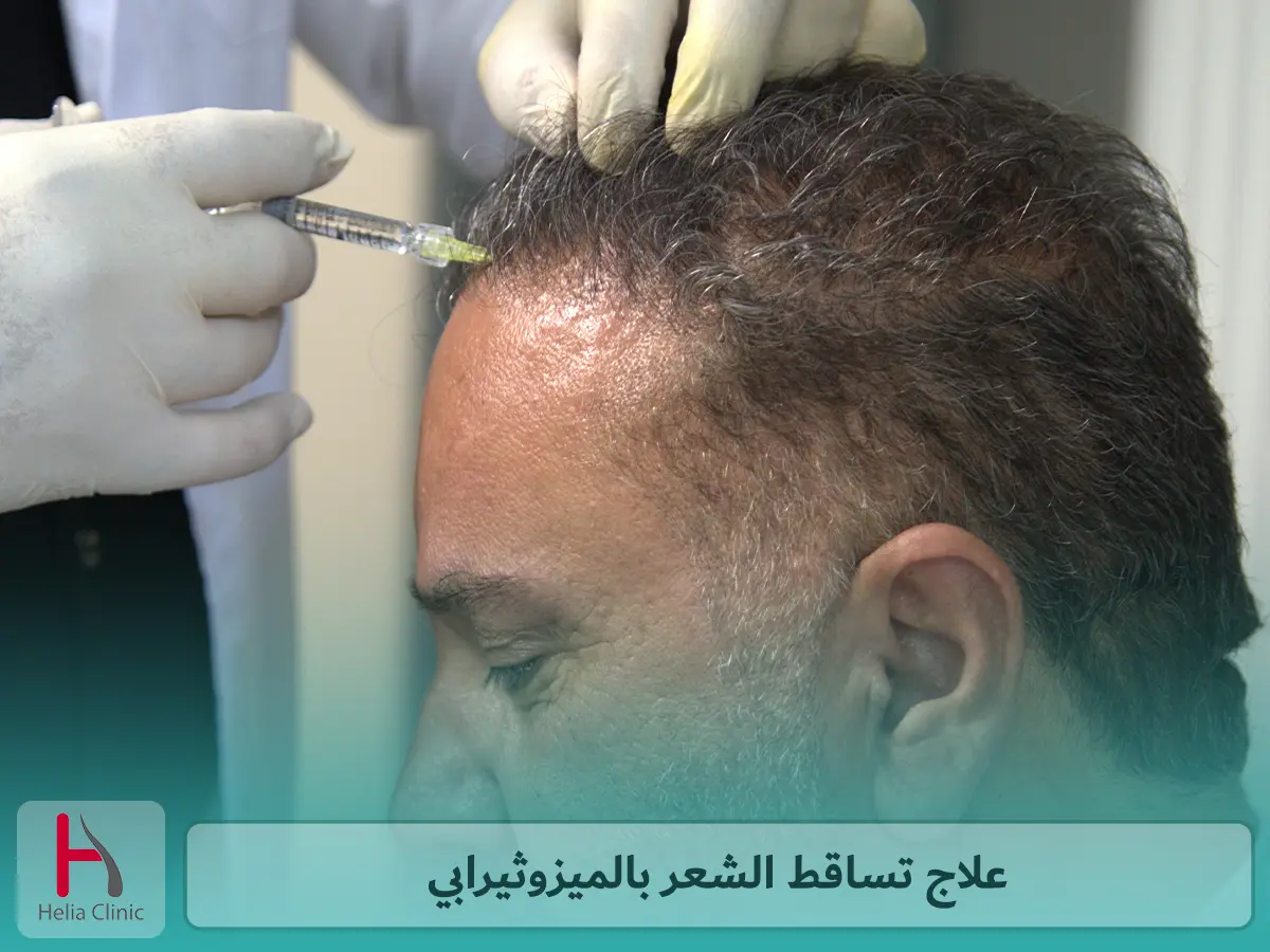 علاج تساقط الشعر بالميزوثيرابي