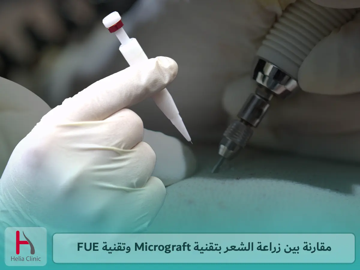 مقارنة بين زراعة الشعر بتقنية Micrograft وتقنية FUE