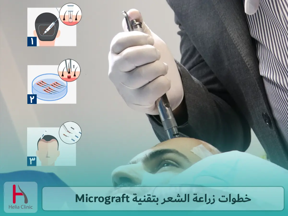 خطوات زراعة الشعر بتقنية Micrograft