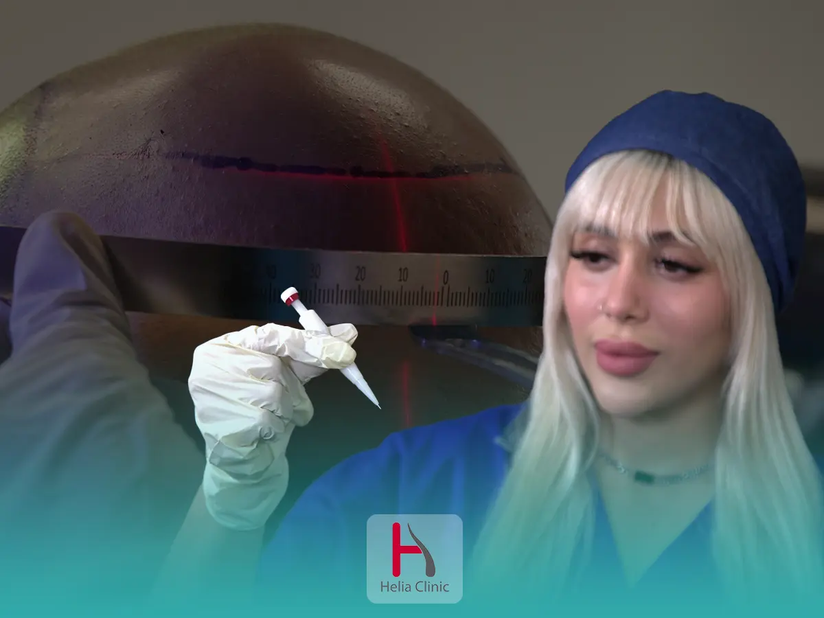 زراعة الشعر بتقنية میکروجرافت