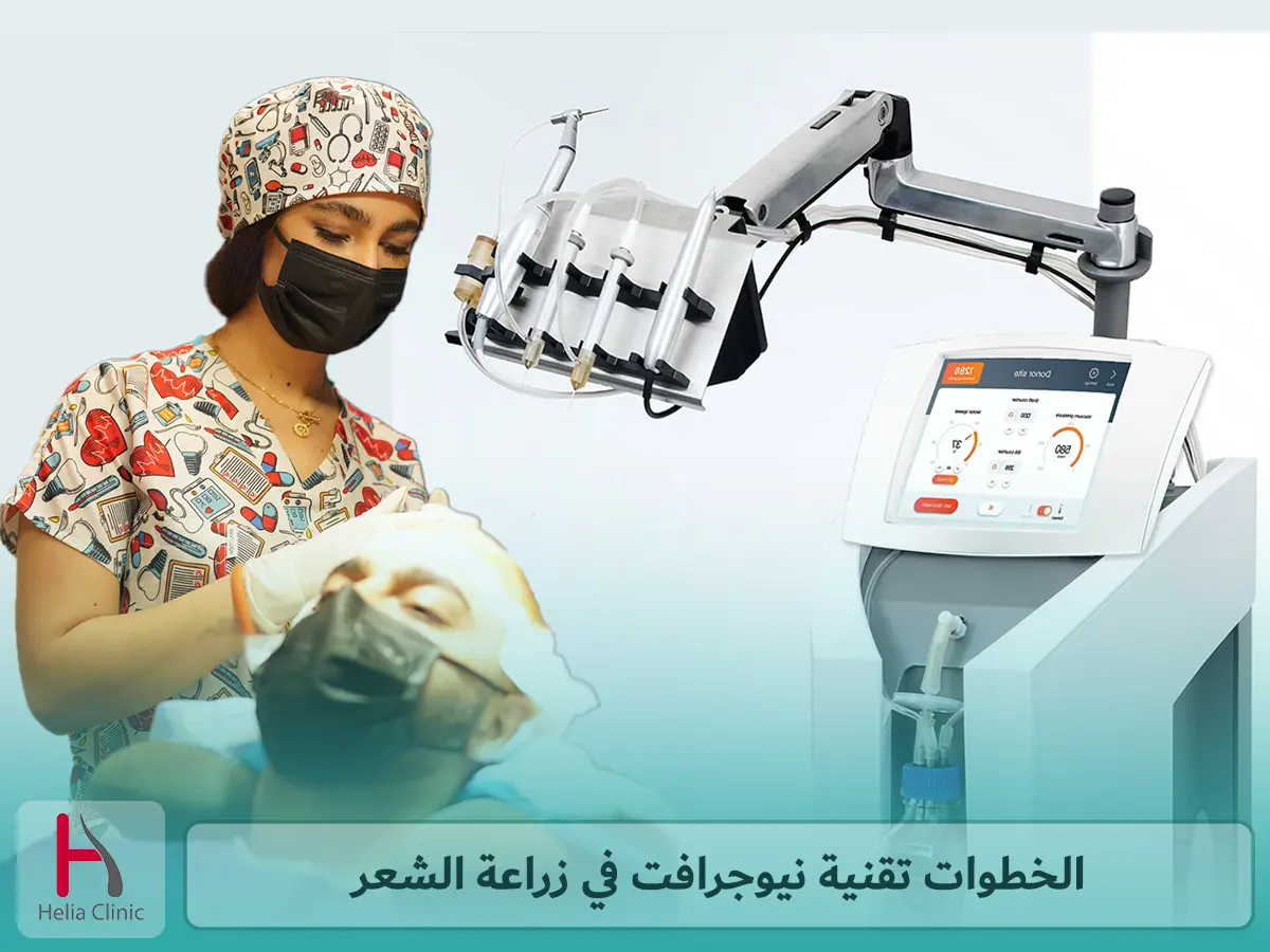 الخطوات تقنية NEOGRAFT نيوجرافت في زراعة الشعر