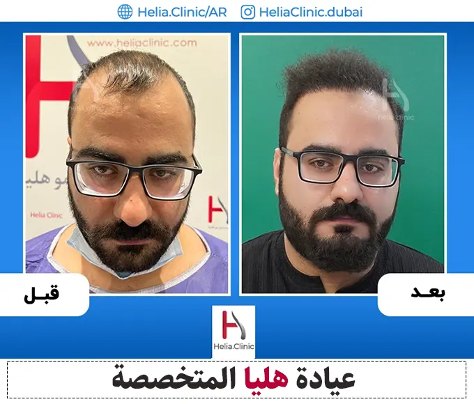 صور زراعة الشعر بطريقة micrograft