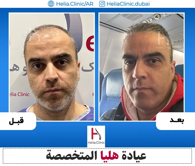عينة من الصورة قبل وبعد زراعة الشعر بتقنية micrograft